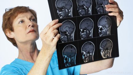 肠道研究令人震惊：肠易激综合征、溃疡和憩室炎与阿尔茨海默病有关